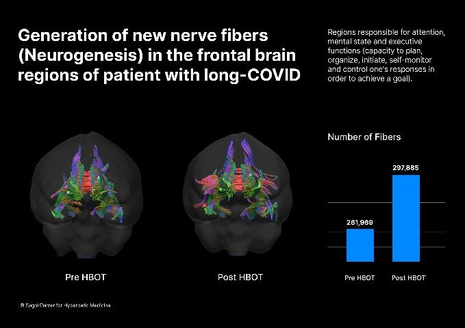 השוואת נוירוגנזה במוח לפני ואחרי טיפול בתא לחץ למטופל עם LONG COVID