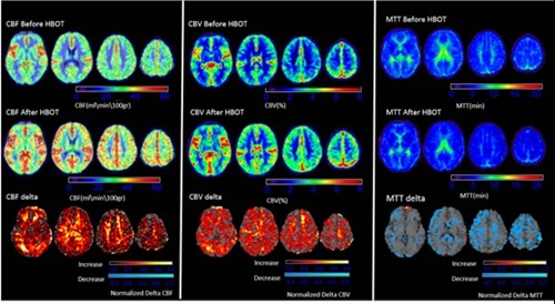 הדמיית MRI של שיפור קוגנטיבי בעקבות טיפול בתא לחץ לאחר חבלת ראש