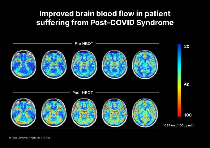 MRI המראה שיפור בזרימת הדם במוח לפני ואחרי טיפול בתא לחץ.